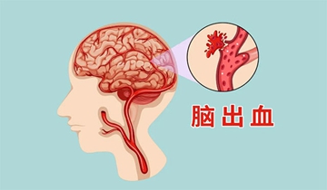 突发内耳眩晕症，内耳眩晕症有可能自愈吗 