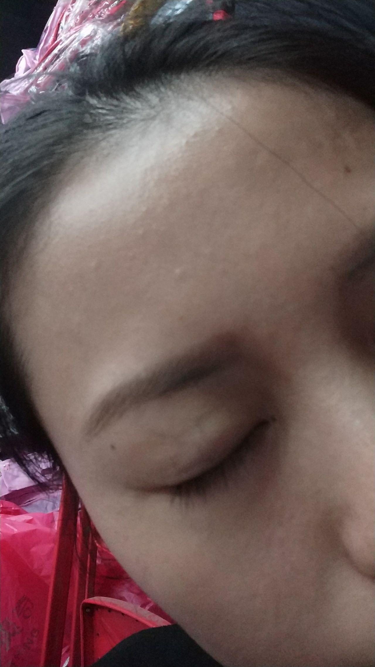 脸上的痣会不断长大吗吗，脸上的痣会长多吗 